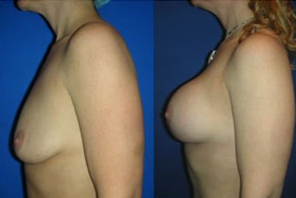 breast augmentation surgery