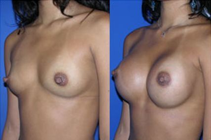 breast augmentation