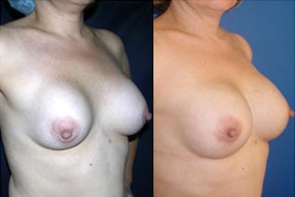 breast implants change surgery