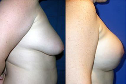 breast elevation with implants