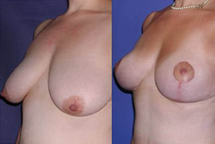 elevación de senos sin implantes