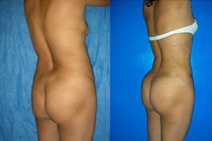 butt surgery