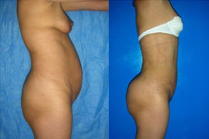 gluteous surgery