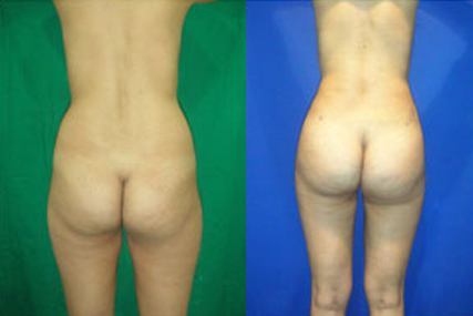 gluteus surgery