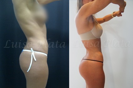buttocks surgery woman