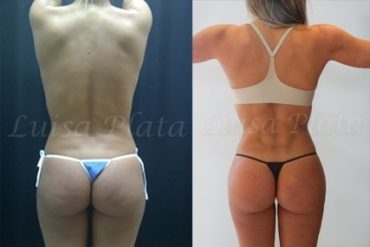 buttocks surgery