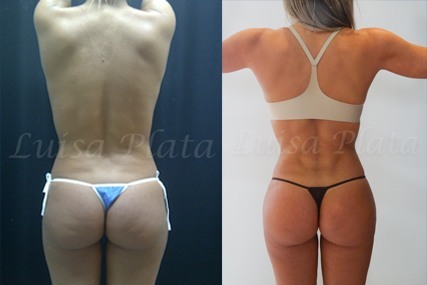 buttocks surgery