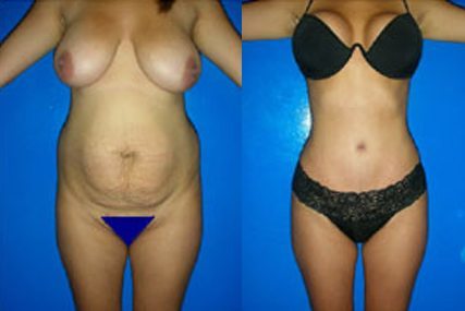 abdomen surgery woman