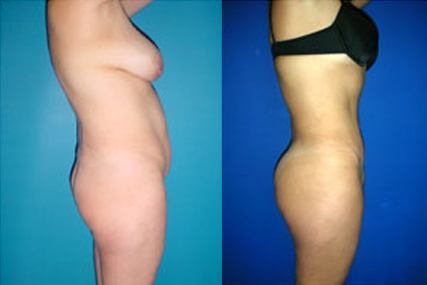 HiDef Lipectomy (Abdominoplasty or Tummy Tuck) - Luisa Plata