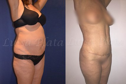 woman body surgery