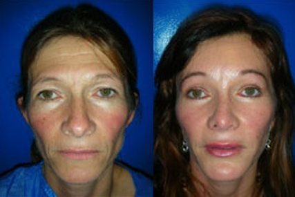 liposucción facial