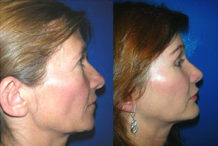 cirugía liposucción facial