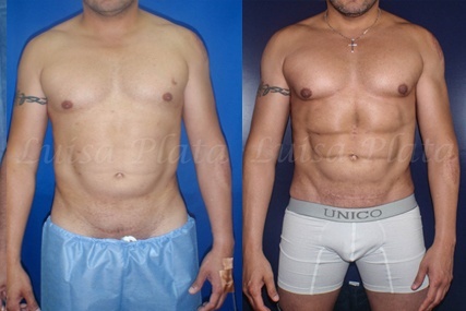 six-pack instantáneo hombre