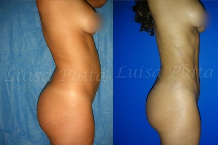 abdominal surgery woman