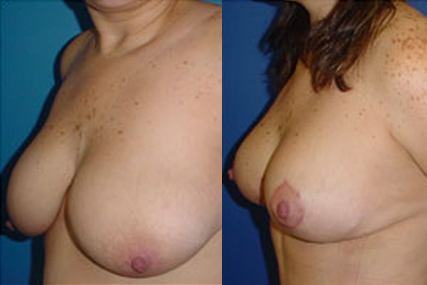 cirugía reducción de senos