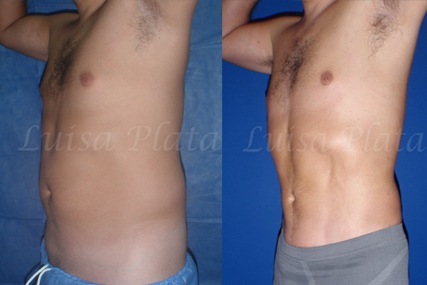 liposuction surgery man