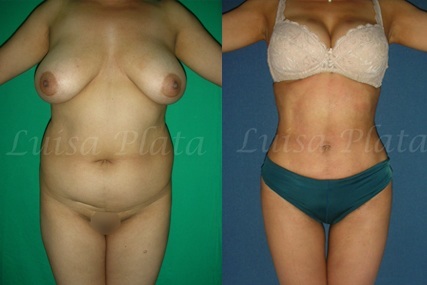 ultra-high definition liposculpture - Dr.HossamTahseen