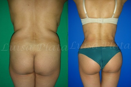 liposuction